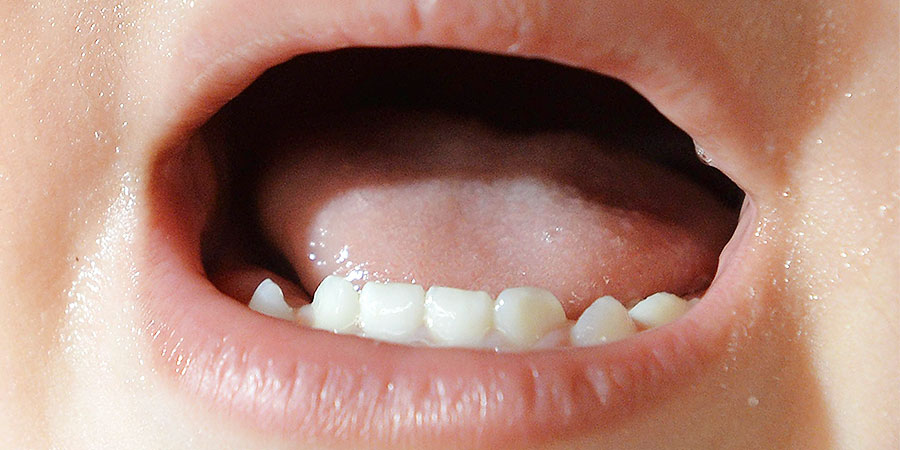 ヘルペス性歯肉口内炎の症状