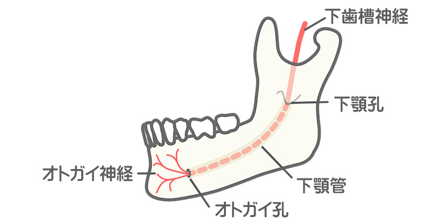 下顎の親知らず抜歯のリスク
