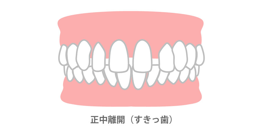 上唇小帯が中切歯の間に挟まると隙間が閉じられず、正中離開になってしまいます。 