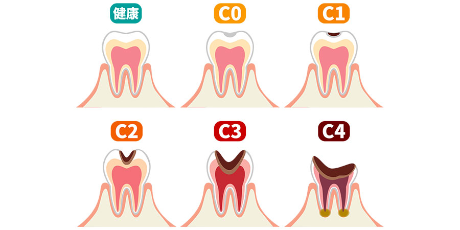 歯を失う原因 2位：虫歯