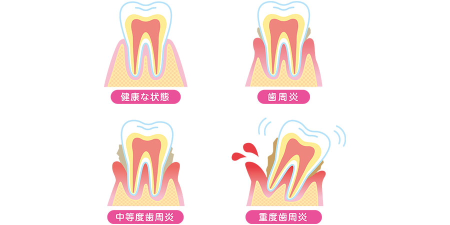 歯を失う原因 1位：歯周病