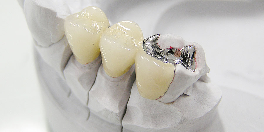 インレーやクラウン治療