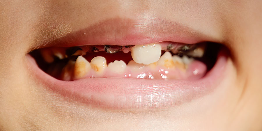 ランパントカリエスとは