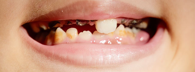 子どもにできやすい虫歯、ランパンドカリエスとは？