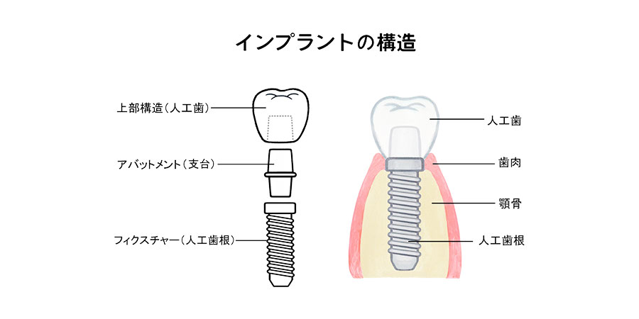 インプラントの構造
