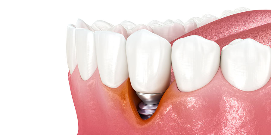 インプラント周囲炎