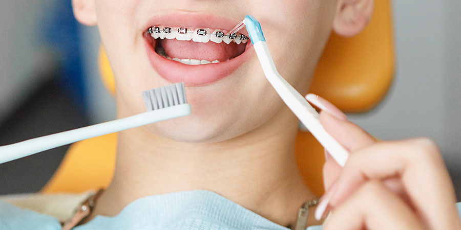 矯正治療中に歯磨きを怠るリスク