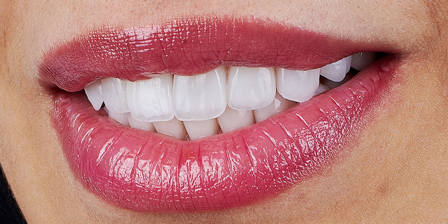 ダイレクトボンディング治療のメリット