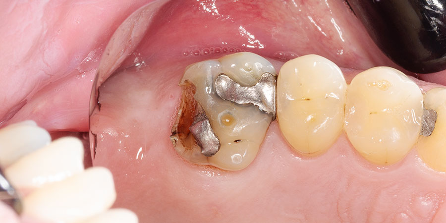 アマルガムとは