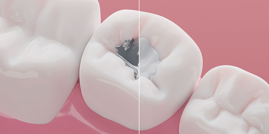 アマルガムを外した後の治療法