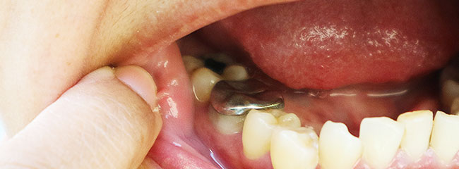 今では使われなくなったアマルガムについて