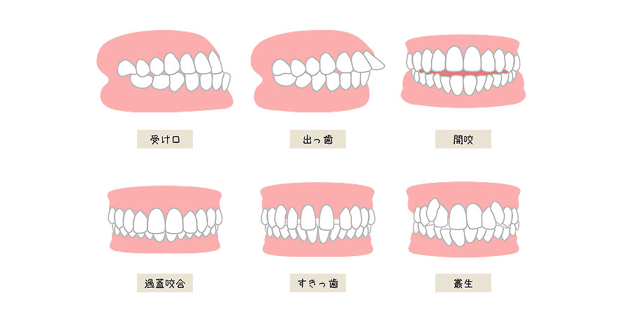 睡眠時無呼吸症候群の歯並びへの影響